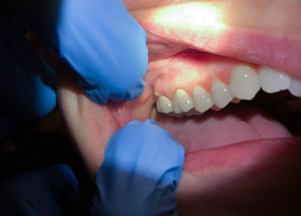 Best Broken or Chipped Tooth Repair in North Randall, OH